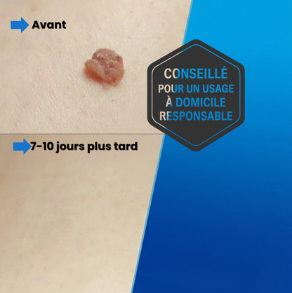 DermaLiss — Kit de retrait d'acrochordons